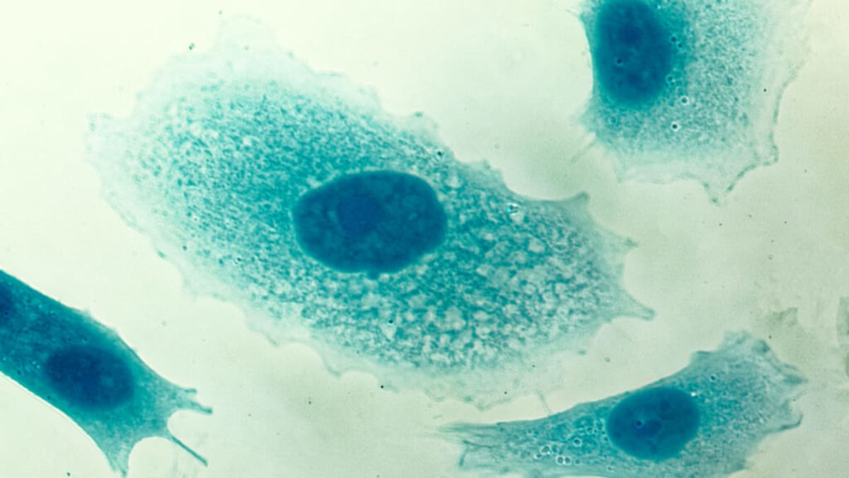 PSA Screening Now Proven to Reduce Prostate Cancer Deaths