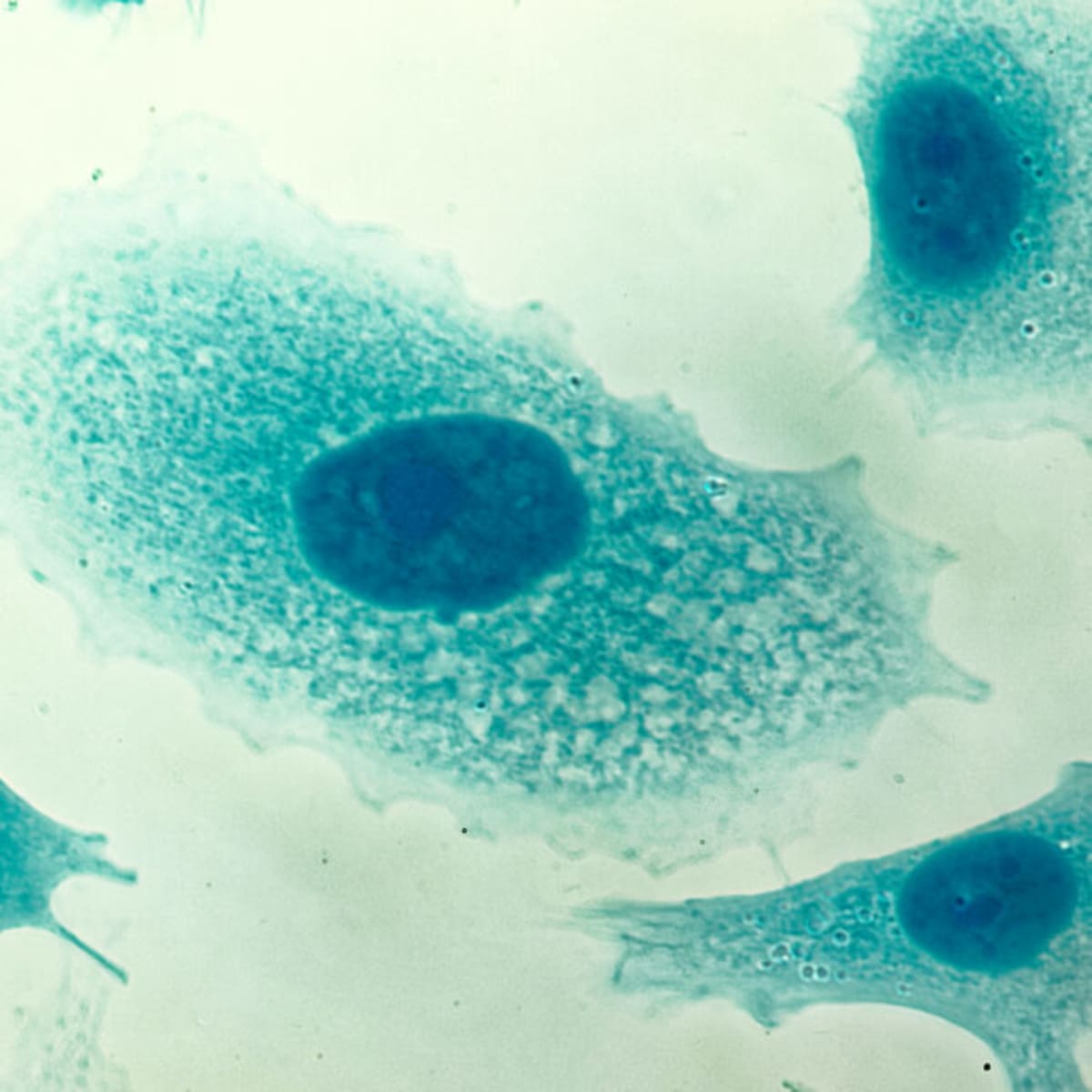 PSA Screening Now Proven to Reduce Prostate Cancer Deaths - Image 2