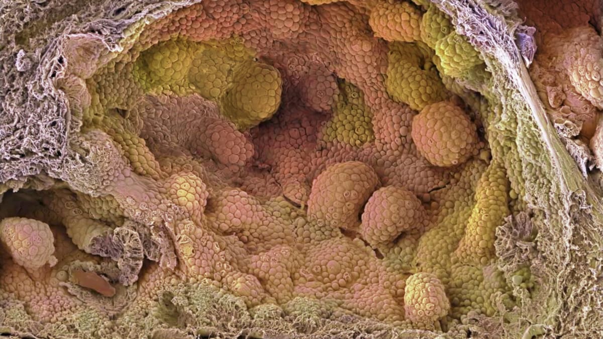 Medical researchers reviewing prostate cancer treatment data showing improved patient outcomes with combination therapy