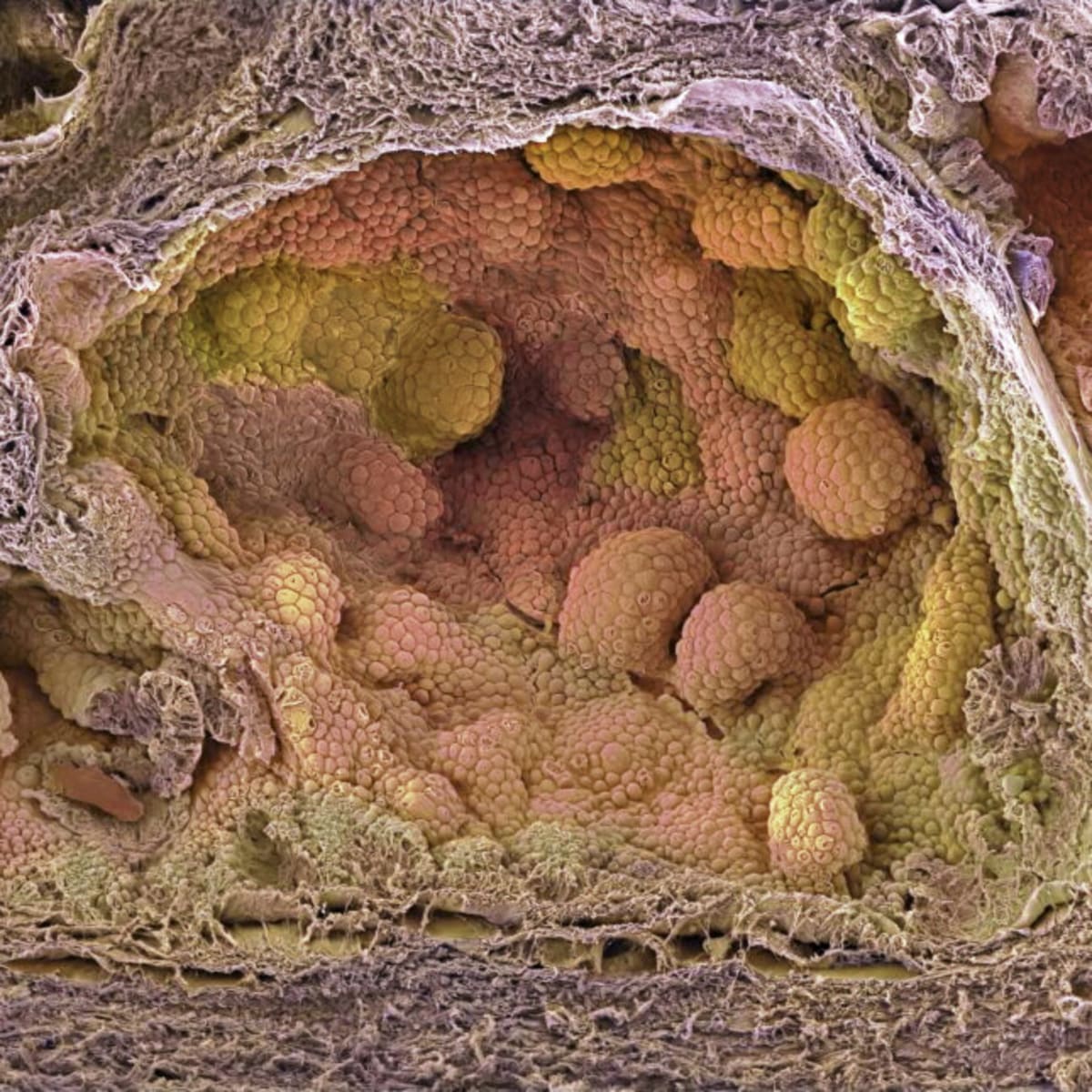 New Hormone Treatment Boosts Prostate Cancer Surgery Results - Image 2