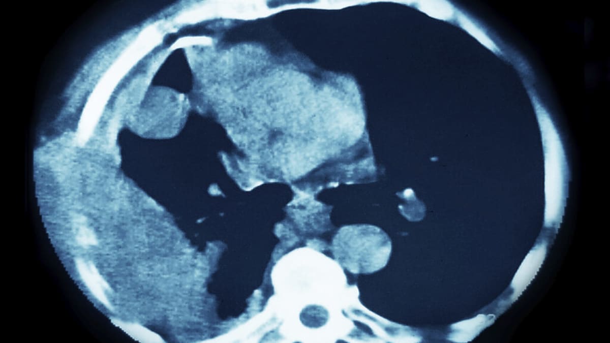 New Lung Cancer Drug Cuts Death Risk by 34% in Trial