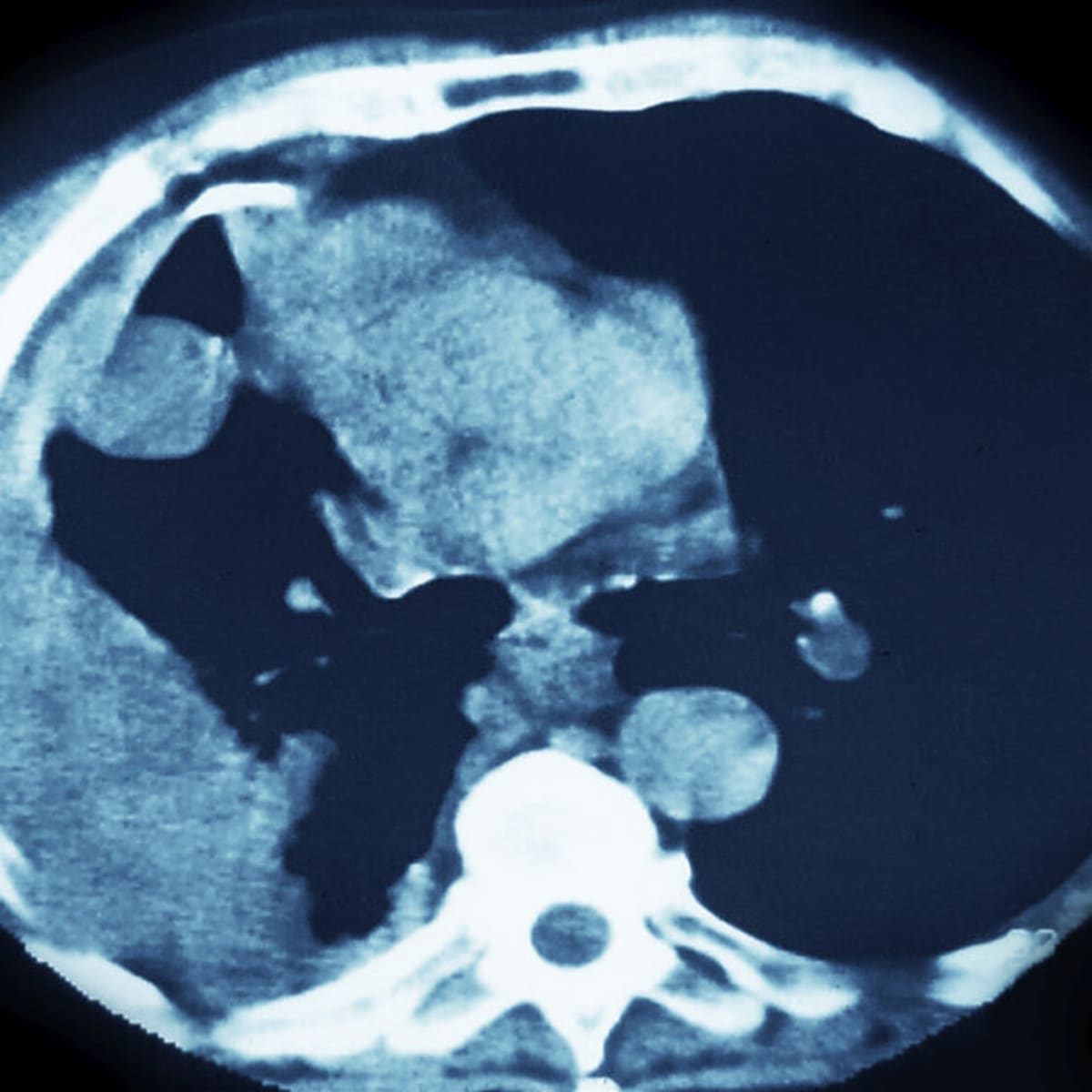 New Lung Cancer Drug Cuts Death Risk by 34% in Trial - Image 2