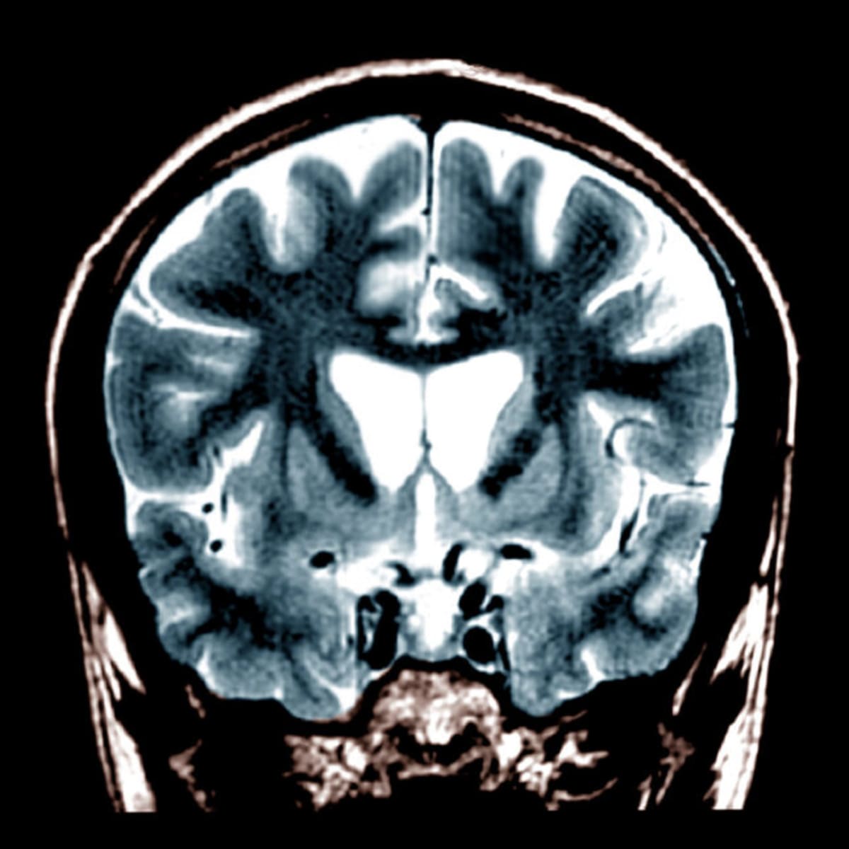 Gene Therapy Startup Raises $42M for Huntington's Trial - Image 2