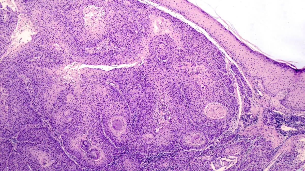FDA Panel Backs New Melanoma Treatment After 2 Rejections