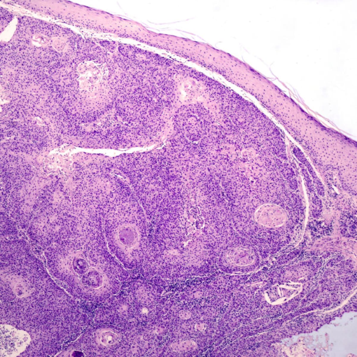 FDA Panel Backs New Melanoma Treatment After 2 Rejections - Image 2