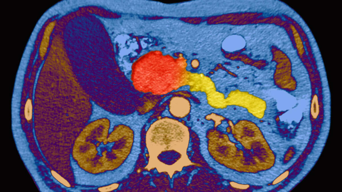 New Pancreatic Cancer Drug Brings Hope to Deadly Disease