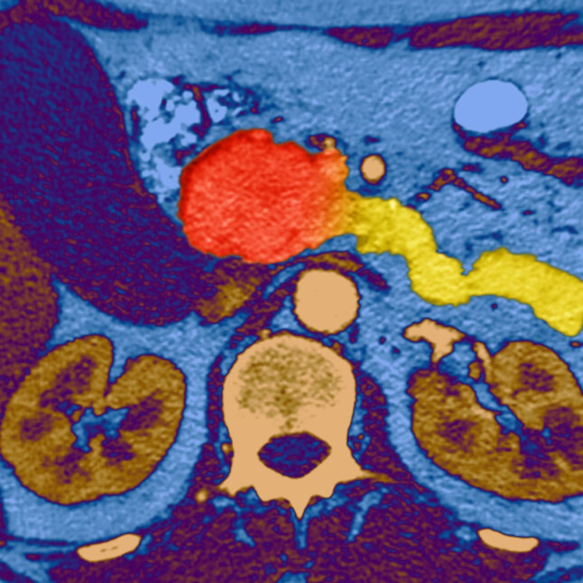 New Pancreatic Cancer Drug Brings Hope to Deadly Disease - Image 2