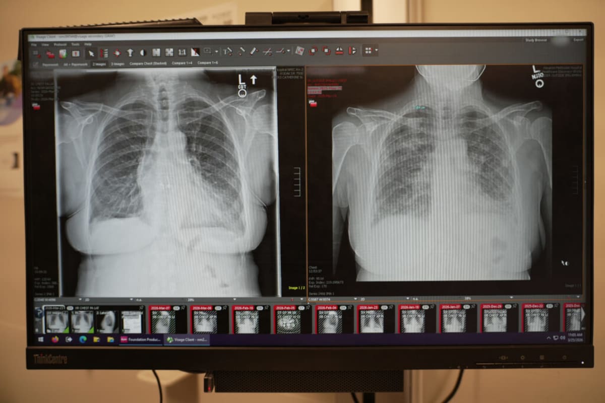Lung Transplants Give Stage 4 Cancer Patients New Hope - Image 3