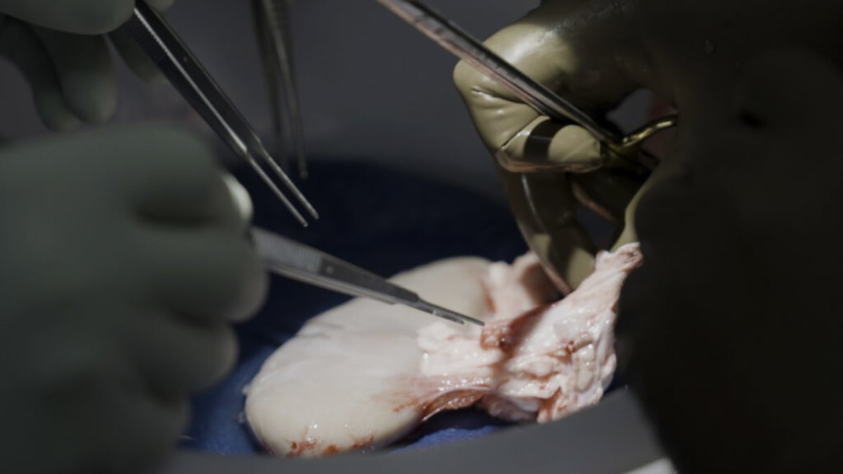 Pig Kidney Patients Get Human Transplants Successfully