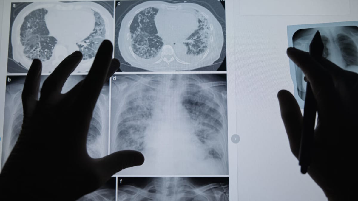 Professor Uses His Own Cancer to Train Future Doctors