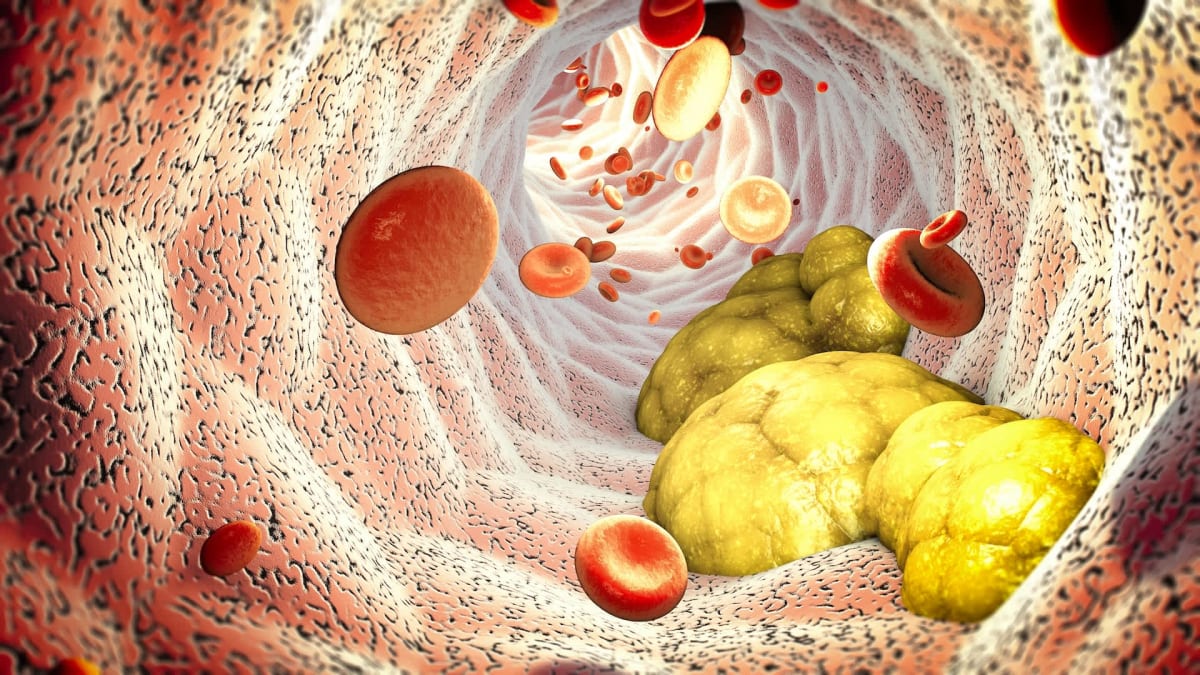Cholesterol Treatment Cuts Forever Chemicals by Up to 76%