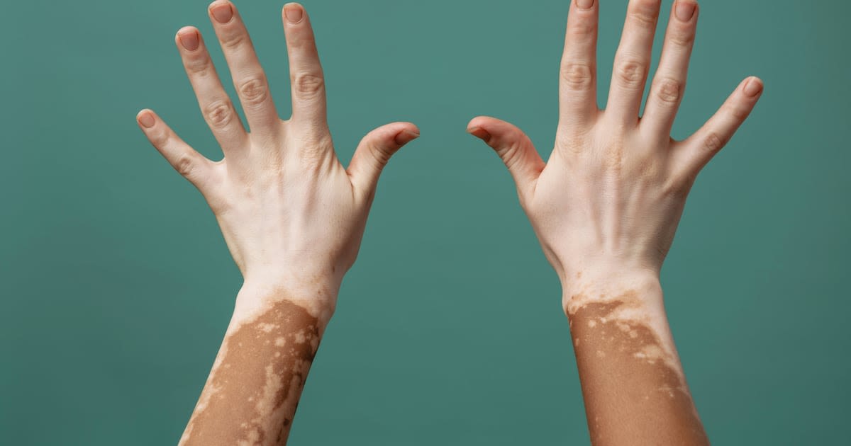 Person taking daily oral medication pill representing new vitiligo treatment option approved in UAE