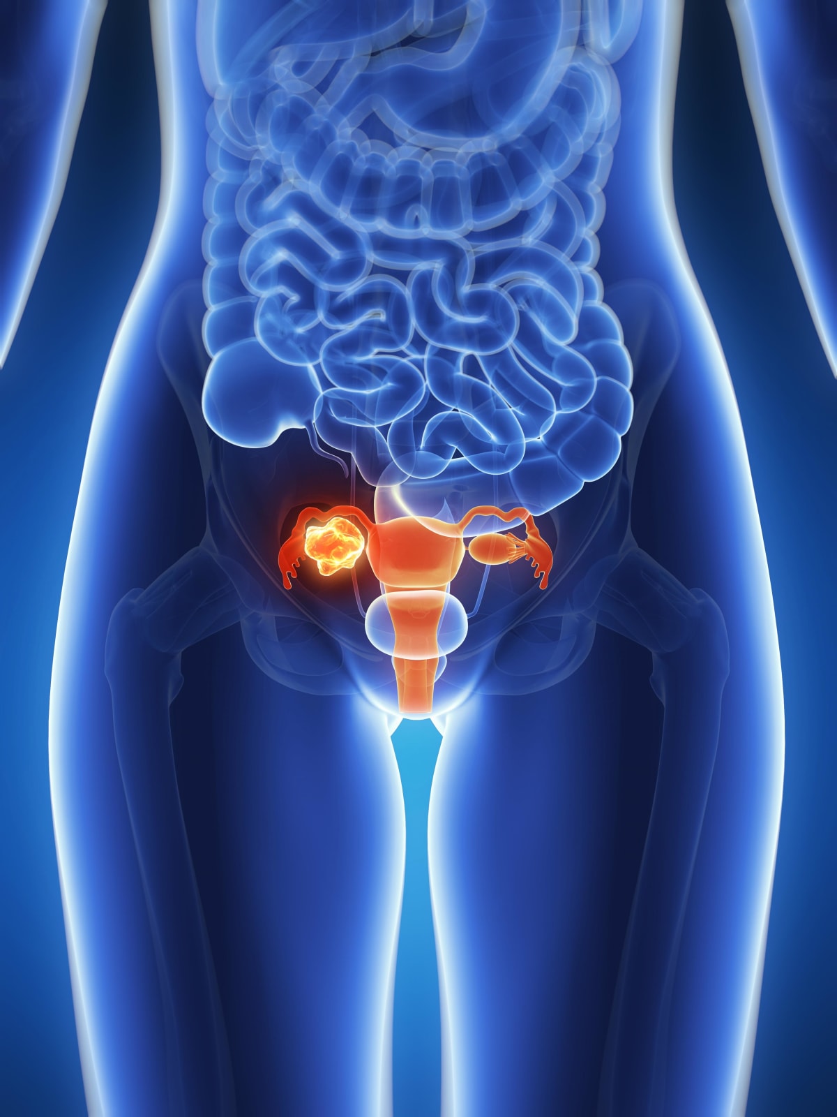 Bladder Cancer Drug Could Spare Thousands From Surgery - Image 2