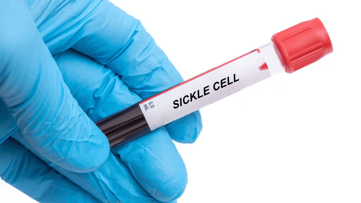 Medical illustration showing comparison between normal round red blood cells and sickle-shaped cells