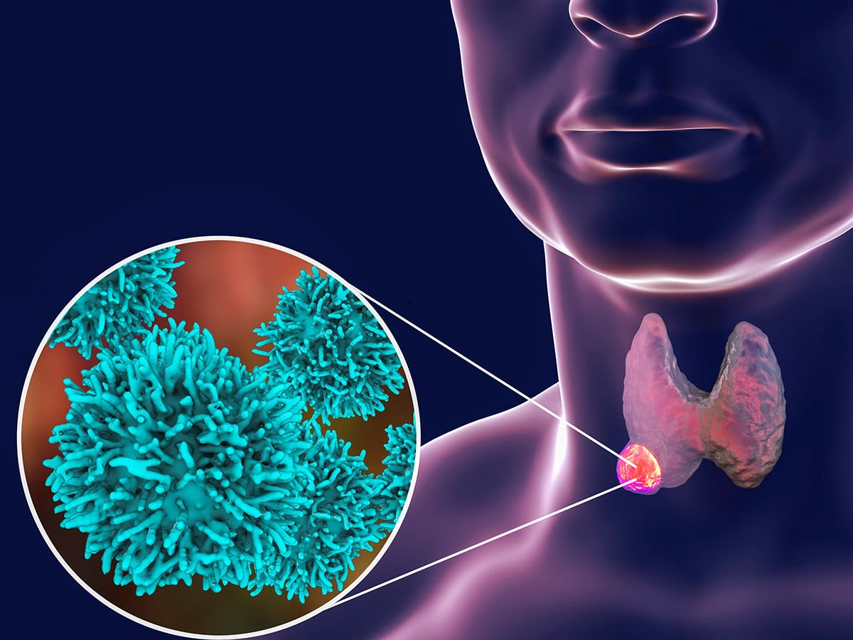 UAB Scientists Find New Hope for Deadly Thyroid Cancer