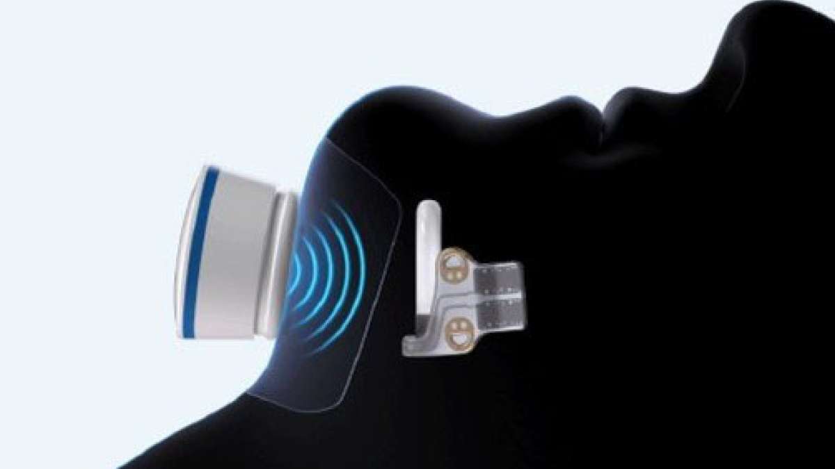 New Sleep Apnea Implant Offers Hope Beyond CPAP Masks