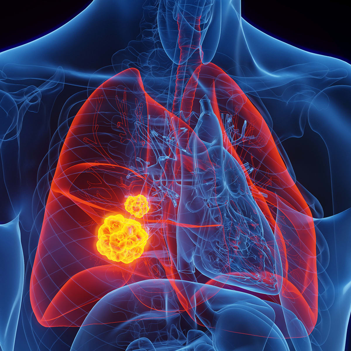 New Antibody Shrinks Drug-Resistant Lung Cancer Tumors