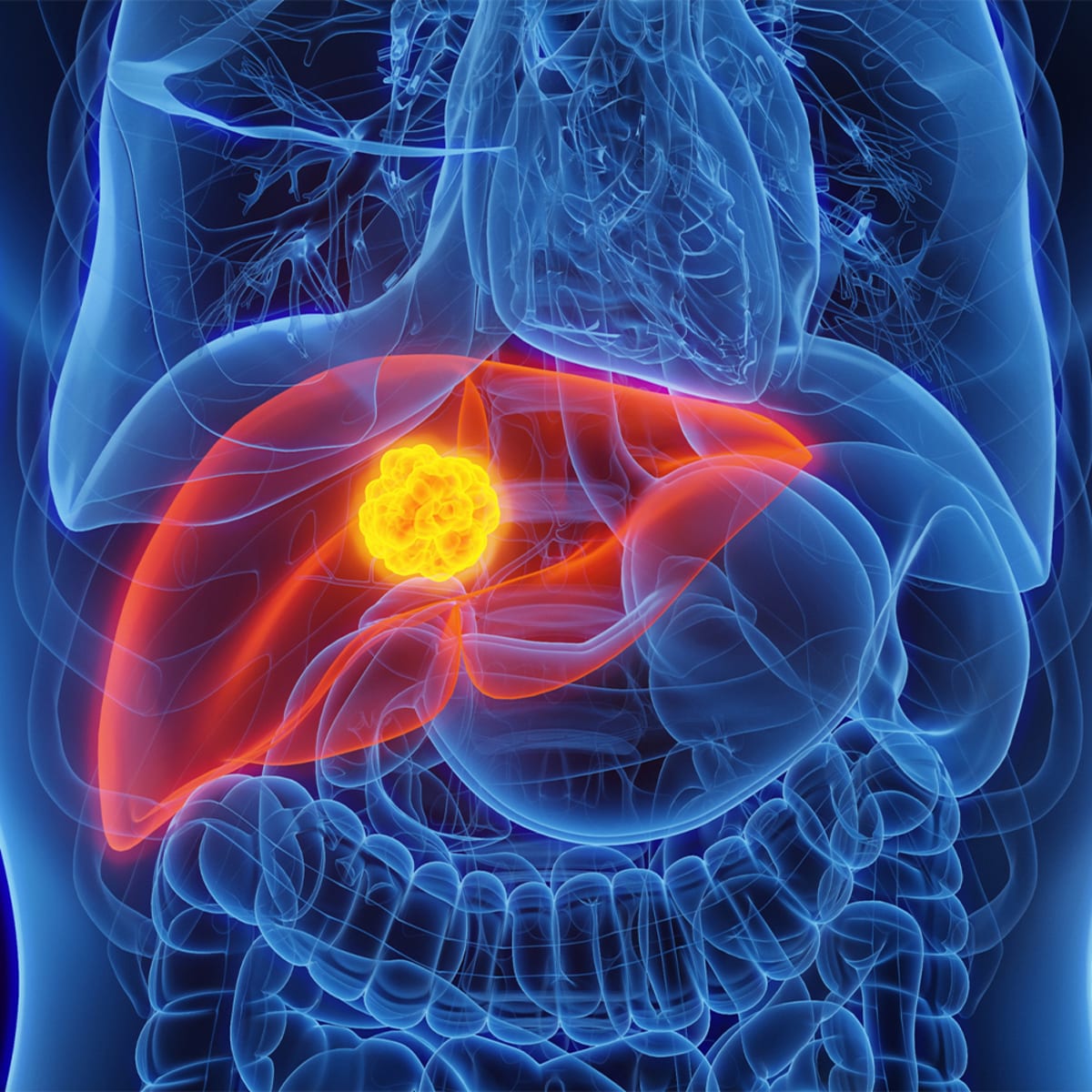 New Liver Cancer Framework Could Save Thousands of Lives