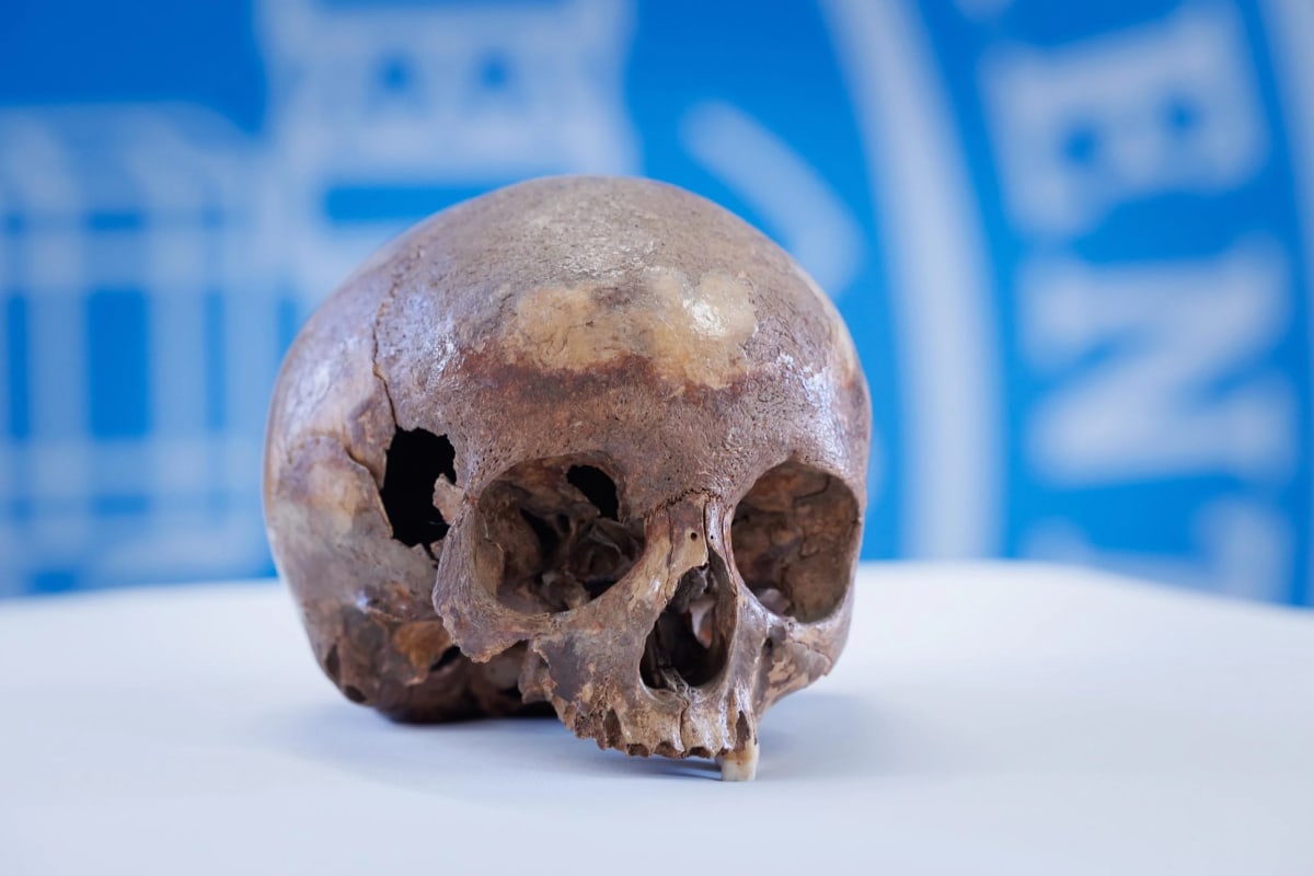 ** Ancient child skull showing archaeological evidence of early surgical medical intervention techniques