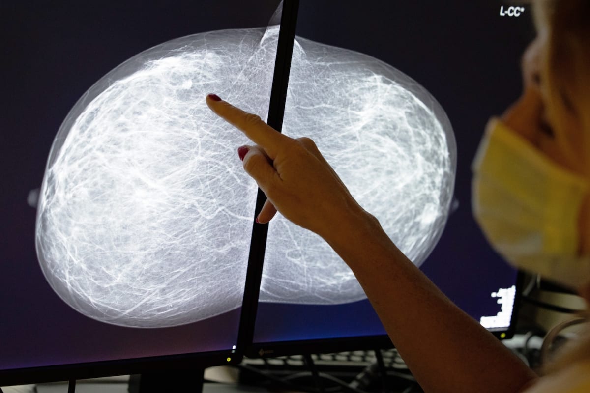 Mammograms Now Detect Heart Disease Risk in Women