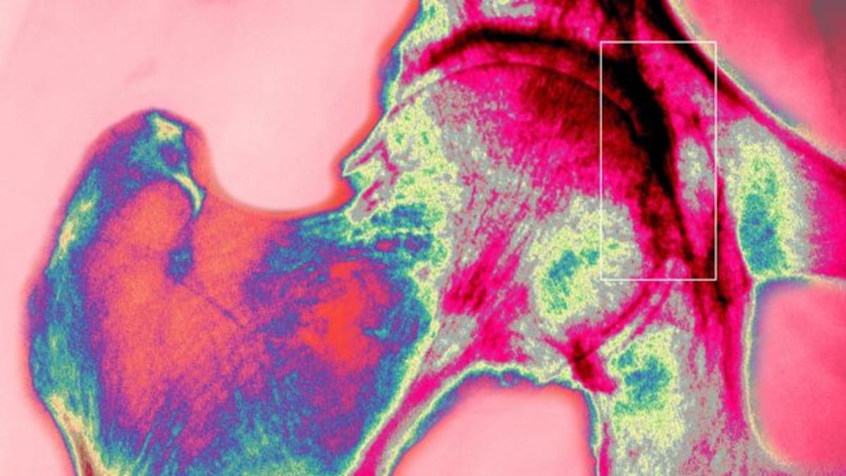 AI Designs Hip Implants That Last Longer Than Ever