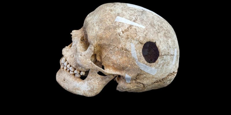 Viking Skull Reveals 9th-Century Brain Surgery Success - Image 2