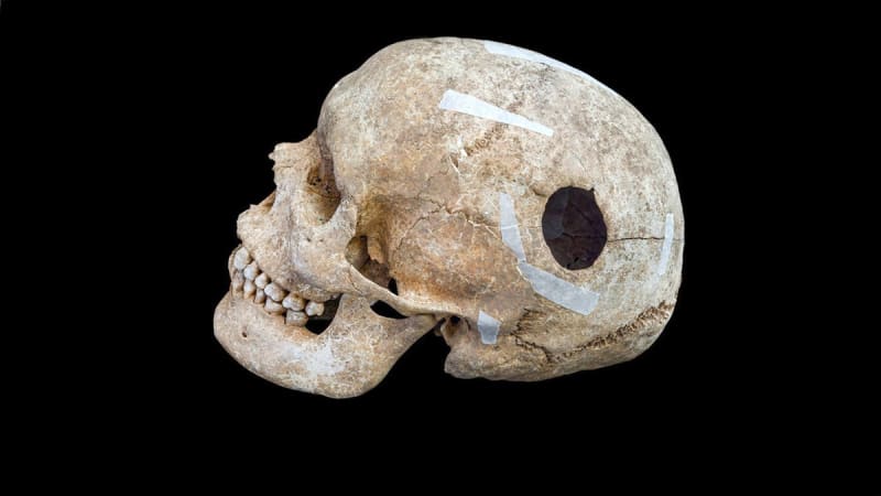 Viking Skull Reveals 9th-Century Brain Surgery Success - Image 4