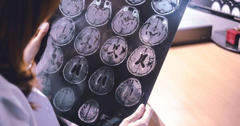 Medical professional reviewing brain scan images showing areas affected by Alzheimer's disease
