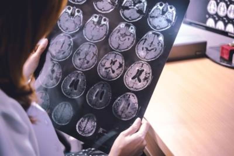 Canada Approves First Alzheimer's Drug That Slows Disease - Image 3