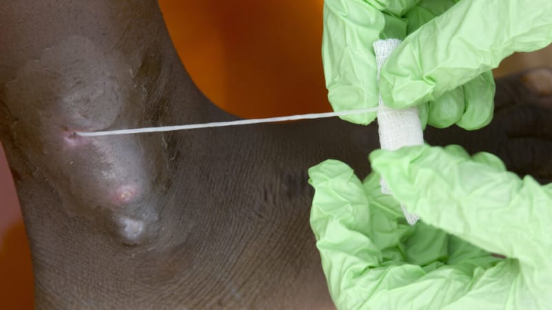 Guinea Worm Near Eradication: Only 10 Cases in 2025