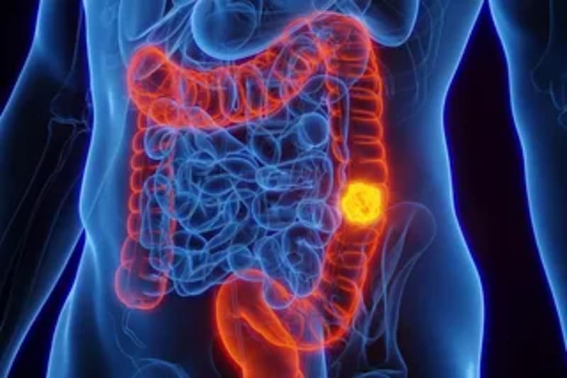 FDA Approves Home Device for Pancreatic Cancer Treatment - Image 4