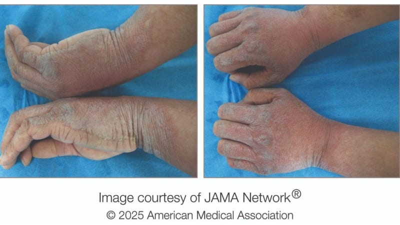 Medical Mystery: Rare Skin Condition Transforms Man's Hands After Washing