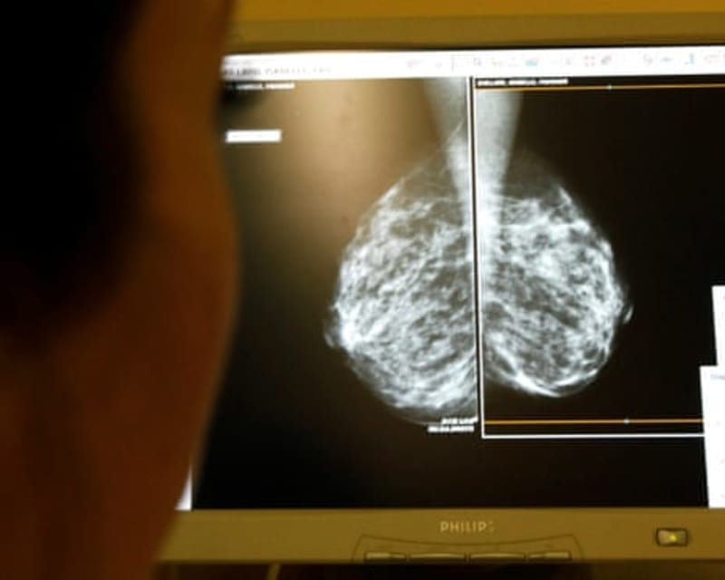 AI Breast Cancer Screening Detects 81% of Tumors Earlier - Image 3