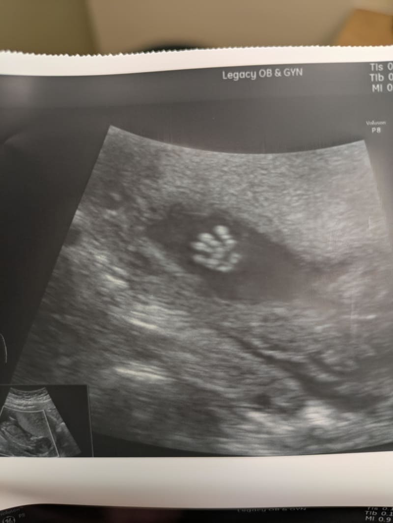 Ultrasound image showing baby appearing to wave at camera during prenatal scan, symbolizing hope after fertility treatments