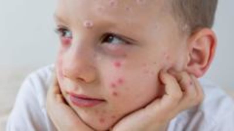 NHS Launches Groundbreaking Chickenpox Vaccine for UK Children