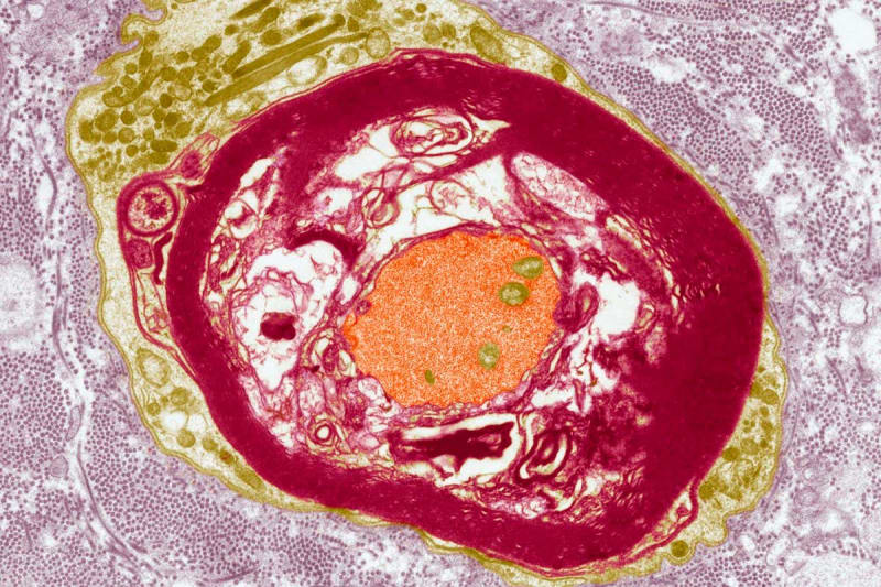 1 in 10 People Carry Genes That Make Them Vulnerable to EBV - Image 4