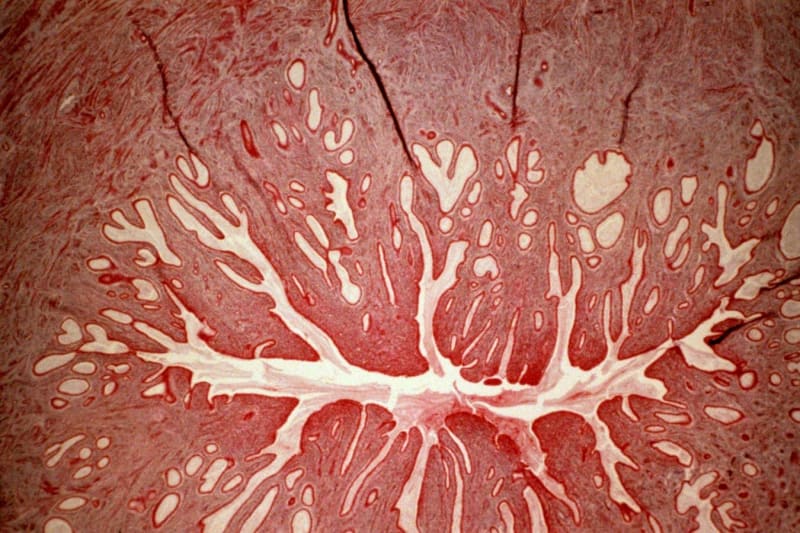 Stem Cell Patch Lets Spina Bifida Kids Walk and Run - Image 4