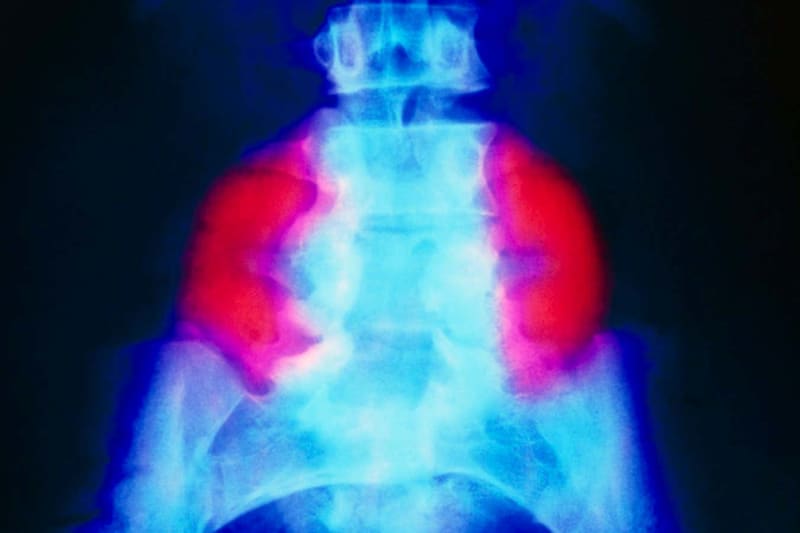 Medical illustration showing spinal cord development in fetus with spina bifida condition