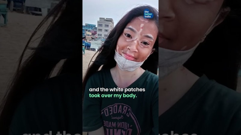 Woman Shunned for Vitiligo Now Thrives as Model