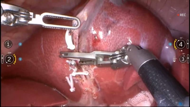 Revolutionary AI-Powered Robot Successfully Performs Complex Surgery Autonomously - Image 3