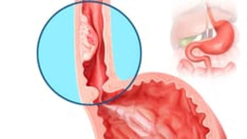 EU Approves First EoE Treatment for Kids Ages 2-17 - Image 3