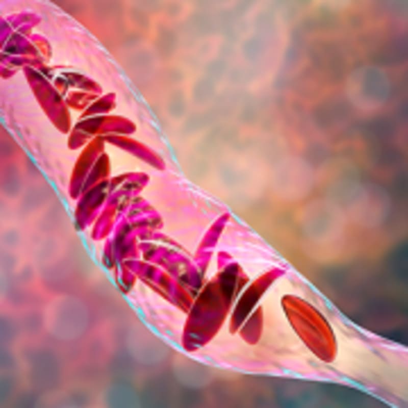 Stem Cell Transplants Now 95% Effective for Sickle Cell - Image 5