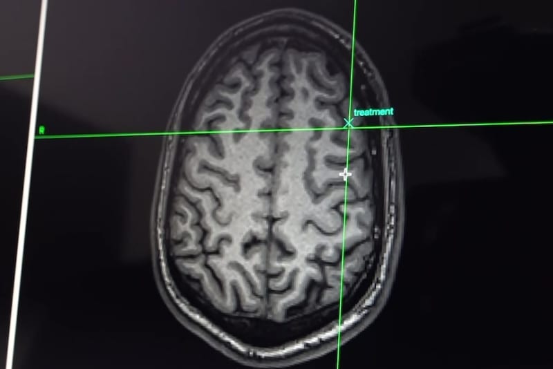 Sunshine Coast Clinic Uses Brain Scans to Treat Depression - Image 3