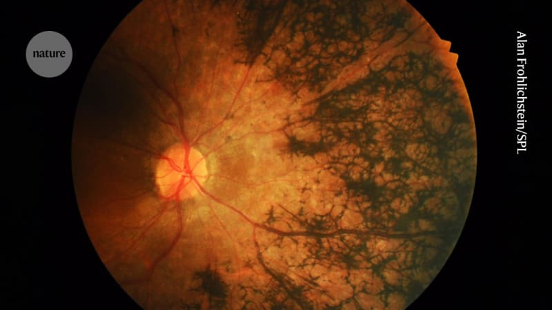 5 Genes Discovered Behind Gradual Blindness in 2M People