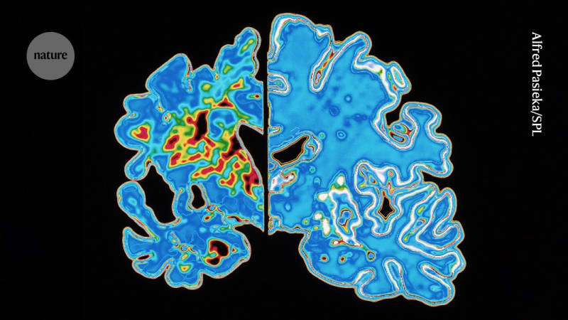 Blood Test May Predict When Alzheimer's Symptoms Begin
