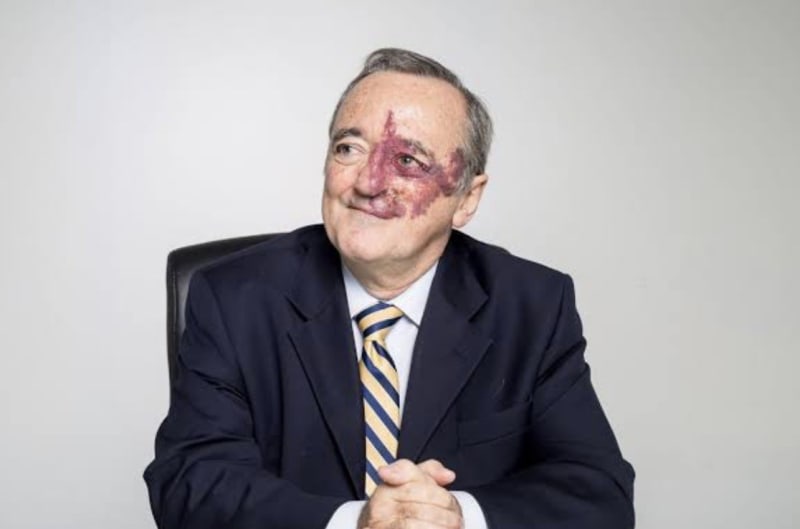 Spanish Lab Eliminates Pancreatic Cancer in Mice