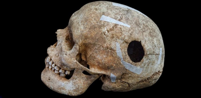 Cambridge Dig Uncovers 9th Century Brain Surgery Evidence - Image 3
