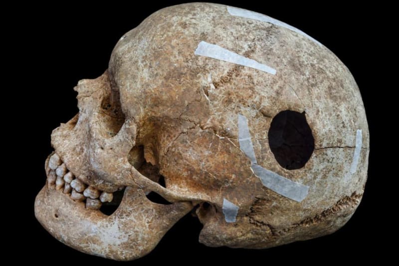 Cambridge Dig Uncovers 9th Century Brain Surgery Evidence - Image 2