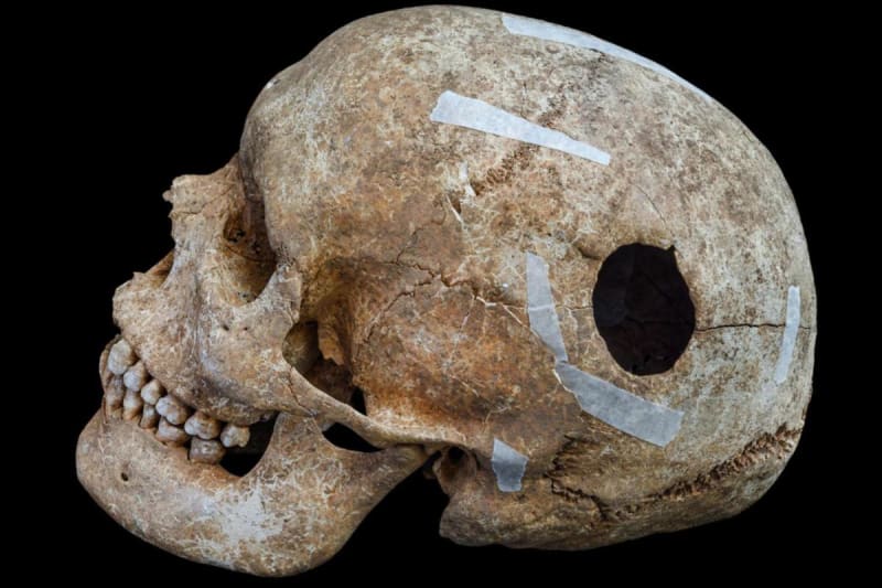 Cambridge Dig Uncovers 9th Century Brain Surgery Evidence