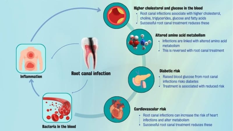 Root Canals May Lower Heart Disease and Diabetes Risk - Image 3